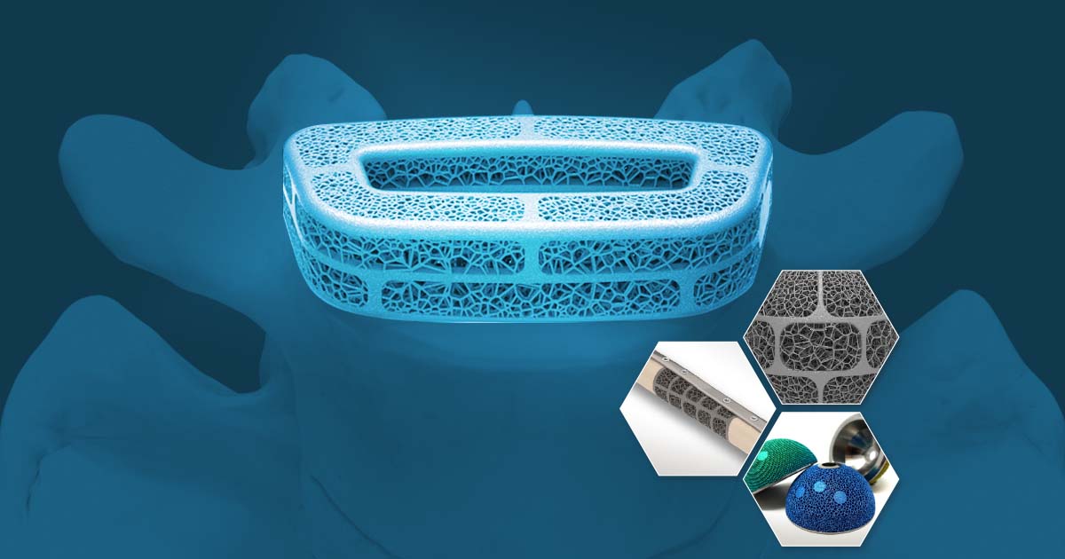 Medical additive manufacturing of orthopedic implants